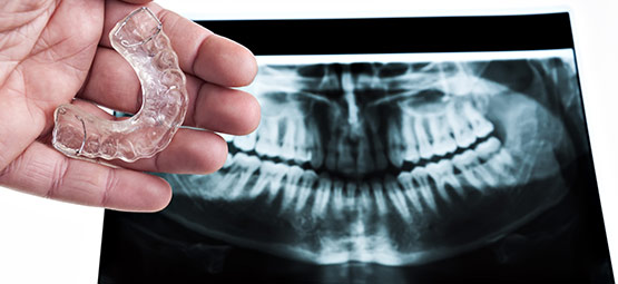 Nächtliches Zähneknirschen kann zu gesundheitlichen Beeinträchtigungen führen. Das Dentallabor Hoffmann fertigt Ihnen professionelle Aufbissschienen.